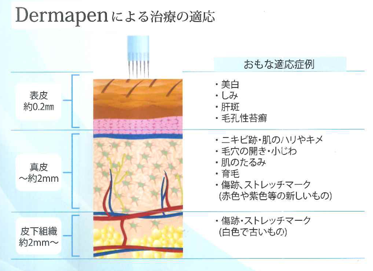 ダーマペン4の治療適応