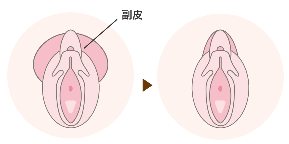 副皮切除とは