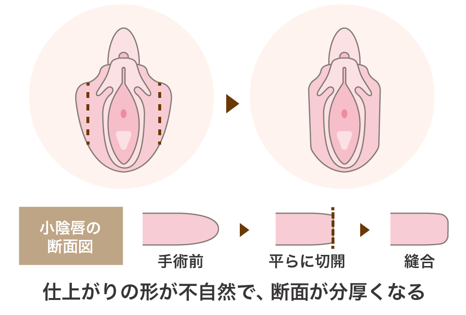 小陰唇縮小治療方法