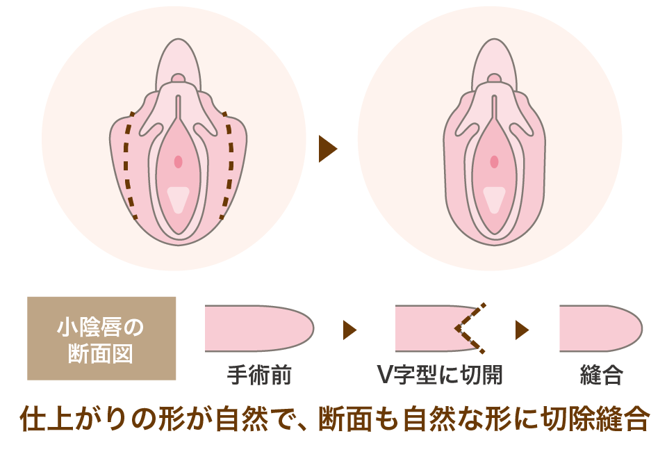 小陰唇縮小治療方法