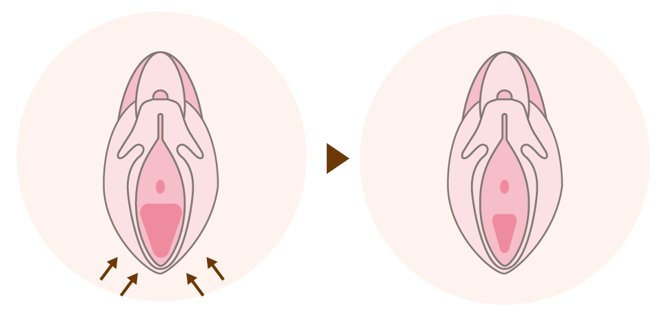 膣縮小とは